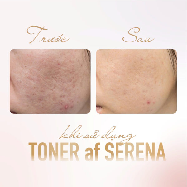 Toner Cấp Ẩm Mờ Thâm, Nám, Tàn Nhang Chống Lão Hoá Da Cân Bằng Da Skanskin Skandi Navisk Toner af Serena 120ml - Hình ảnh 5